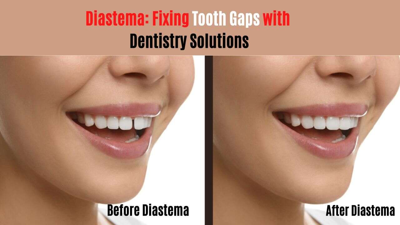 Diastema Fixing Tooth Gaps with Dentistry Solutions